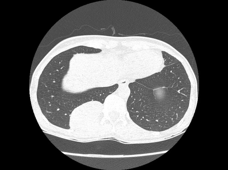 File:Bronchogenic cyst (Radiopaedia 80273-93615 Axial lung window 23).jpg