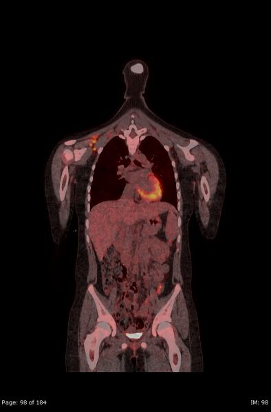 File:Brown fat uptake (FDG PET-CT) (Radiopaedia 77392-89513 Fused coronal 56).jpg