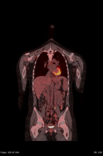 File:Brown fat uptake (FDG PET-CT) (Radiopaedia 77392-89513 Fused coronal 58).jpg