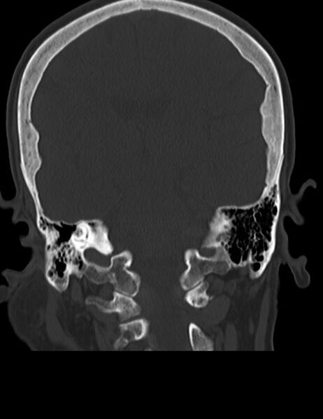 File:Burnt-out meningioma (Radiopaedia 51557-57337 Coronal bone window 32).jpg