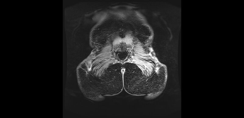 File:Buttock filler complications (Radiopaedia 63497-72115 Coronal T1 C+ 55).jpg