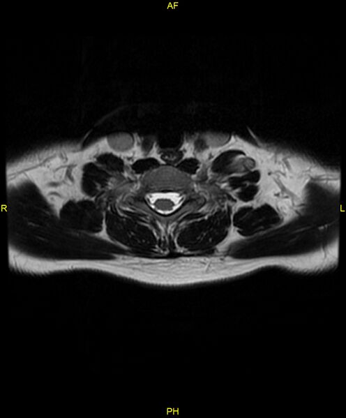 File:C5 nerve sheath tumor (Radiopaedia 85777-101596 Axial T2 61).jpg