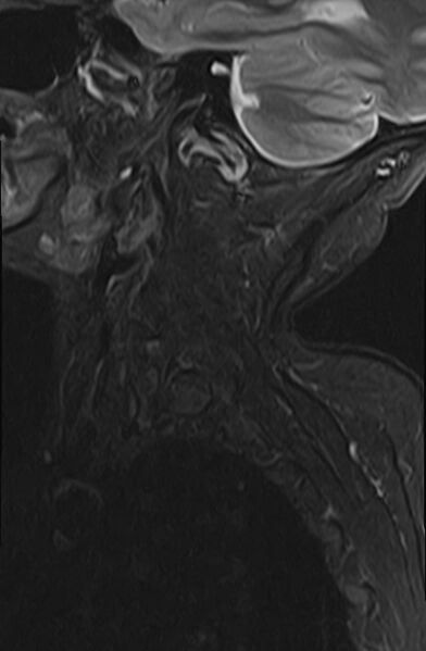 File:Calcified meningioma - cervical canal (Radiopaedia 70136-82468 Sagittal STIR 1).jpg