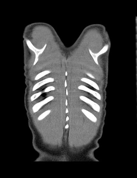 File:Calcifying pulmonary metastases (Radiopaedia 33359-34396 Coronal non-contrast 1).jpg