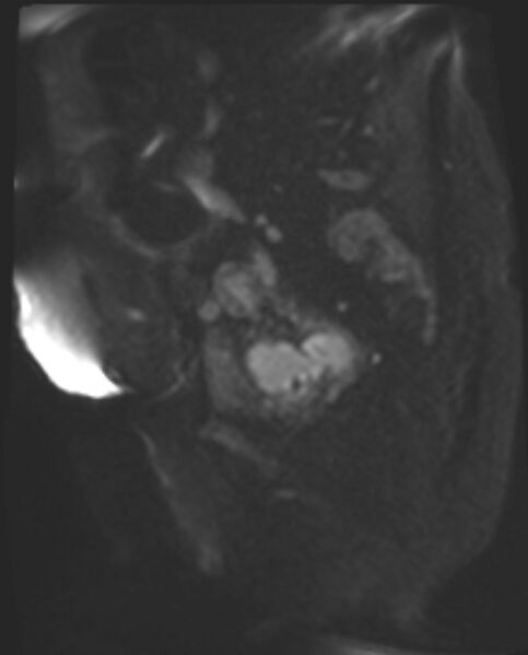 File:Cancer cervix - stage IIb (Radiopaedia 75411-86615 Sagittal DWI 55).jpg