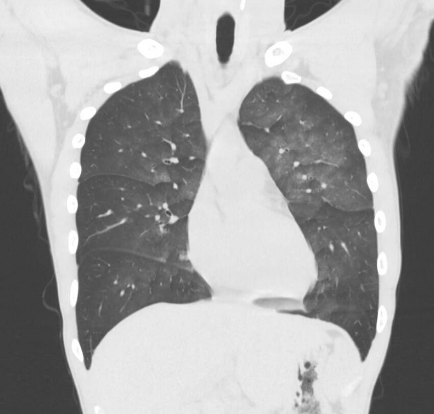 Cannabis-induced diffuse alveolar hemorrhage (Radiopaedia 89834-106946 Coronal lung window 59).jpg
