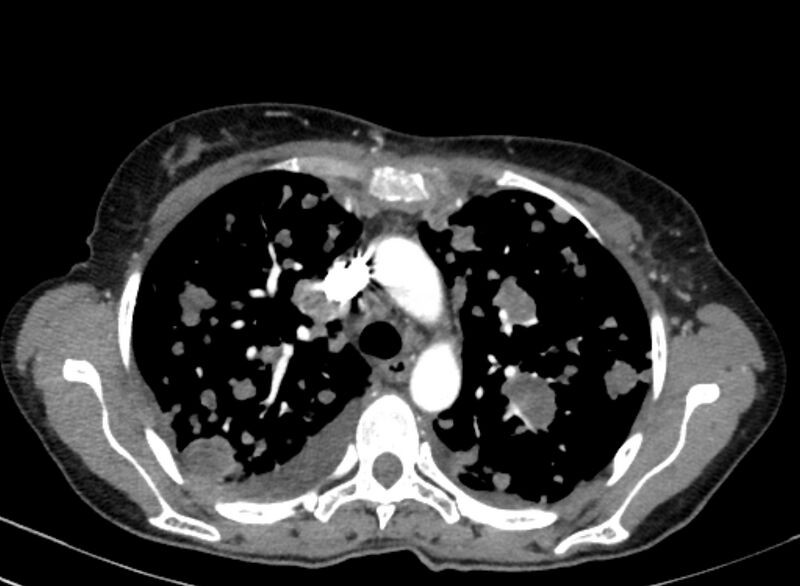 File:Cannonball metastases from breast cancer (Radiopaedia 91024-108569 A 41).jpg