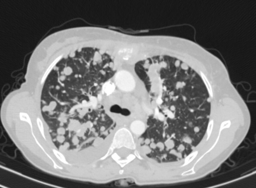 Cannonball metastases from breast cancer (Radiopaedia 91024-108569 Axial lung window 32).jpg
