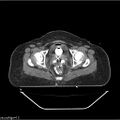 Carcinoma cervix- brachytherapy applicator (Radiopaedia 33135-34173 Axial non-contrast 34).jpg
