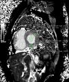 Cardiac amyloidosis (Radiopaedia 51404-57155 C 1).jpg
