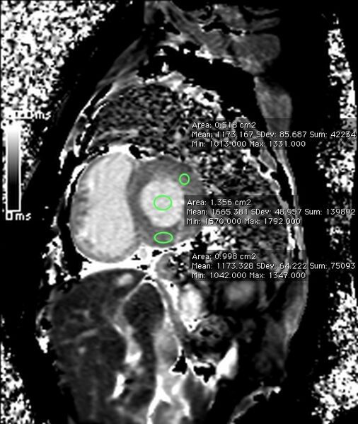File:Cardiac amyloidosis (Radiopaedia 51404-57155 C 1).jpg