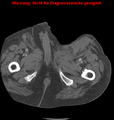 Cardiac perforation following transcatheter aortic valve implantation (Radiopaedia 23714-23863 B 21).png