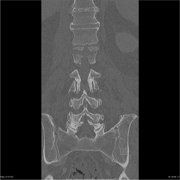 File:Cardiac trauma (Radiopaedia 32874-33858 Coronal bone window 67).jpg