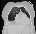 Cardiogenic pulmonary edema (Radiopaedia 29213-29609 Coronal lung window 16).jpg