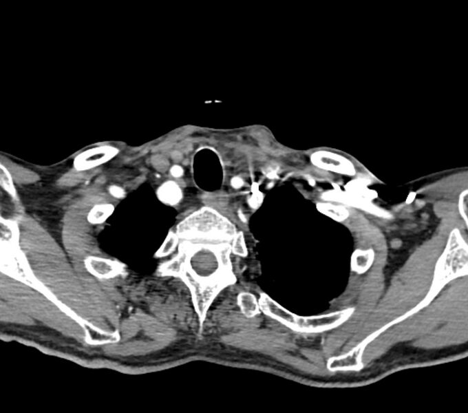 File:Carotid artery pseudoaneurysm (Radiopaedia 84030-99259 C 74).jpg