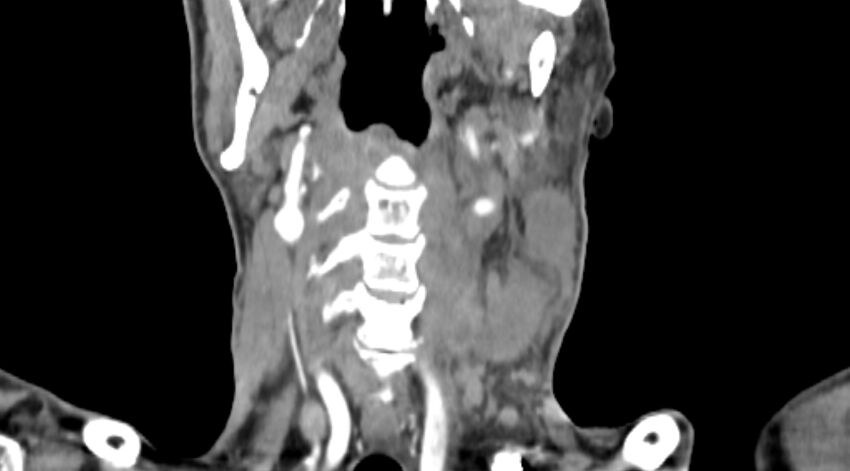 Carotid artery pseudoaneurysm (Radiopaedia 84030-99259 D 49).jpg