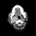 Carotid body tumor (Radiopaedia 27890-28124 A 12).jpg