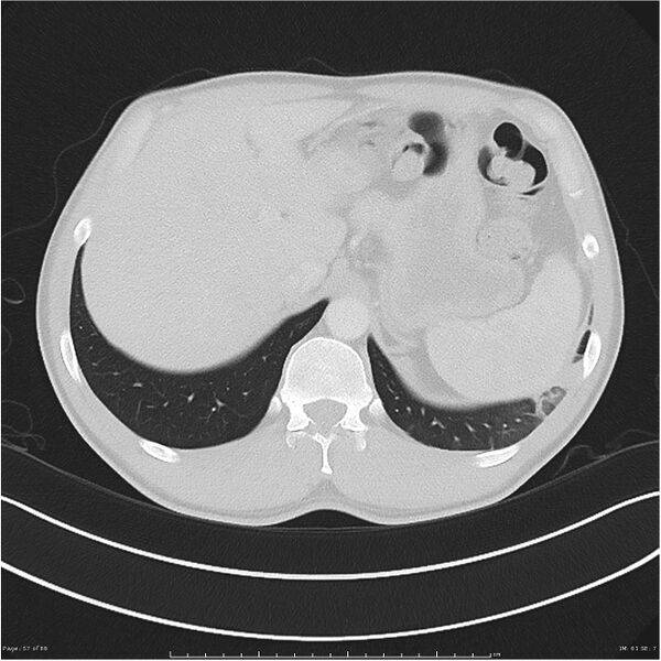 File:Cavitating lung cancer (Radiopaedia 25796-25945 Axial lung window 57).jpg