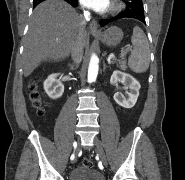 File:Celiac artery dissection (Radiopaedia 52194-58080 C 79).jpg