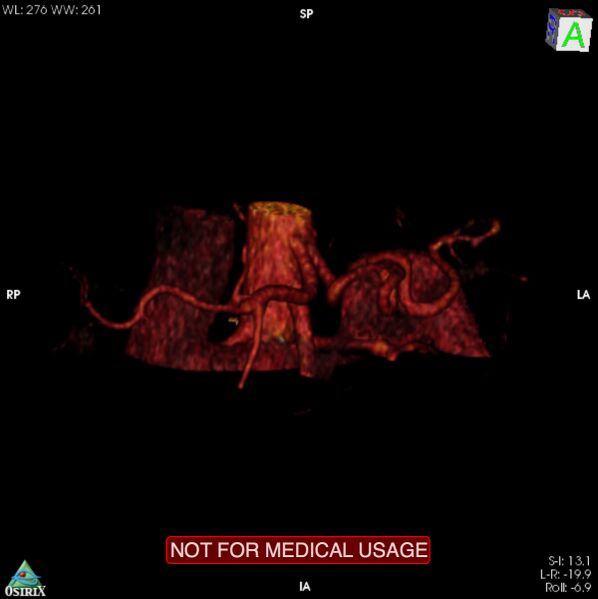File:Celiac trunk variant anatomy - gastrohepatic trunk and splenic artery (Radiopaedia 38815-40995 B 4).jpg