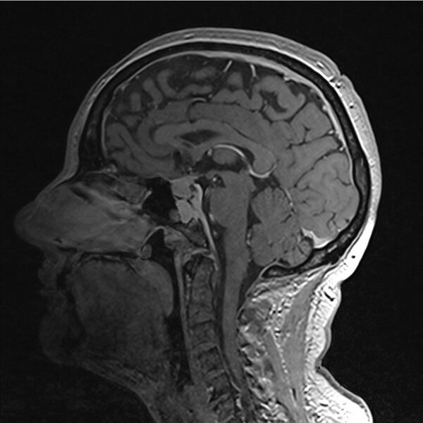 File:Central base of skull meningioma (Radiopaedia 53531-59549 Sagittal T1 C+ 23).jpg