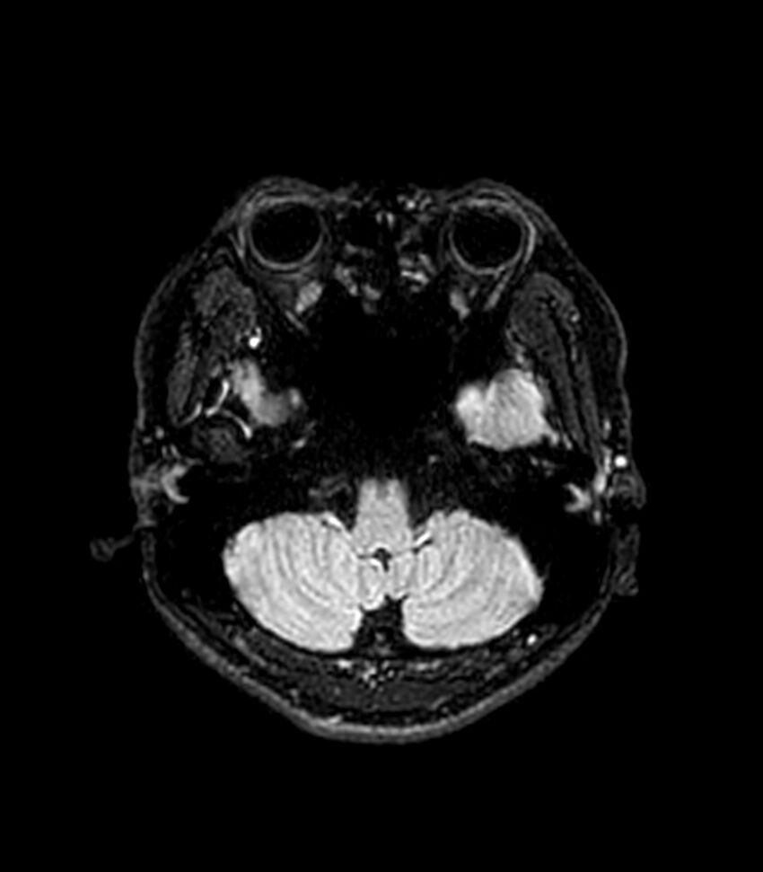 Central neurocytoma (Radiopaedia 79320-92380 Axial FLAIR 241).jpg