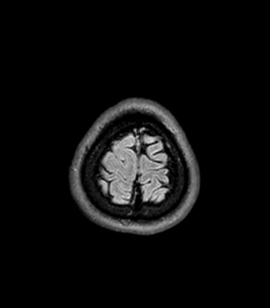 File:Central neurocytoma (Radiopaedia 79320-92380 Axial FLAIR 43).jpg