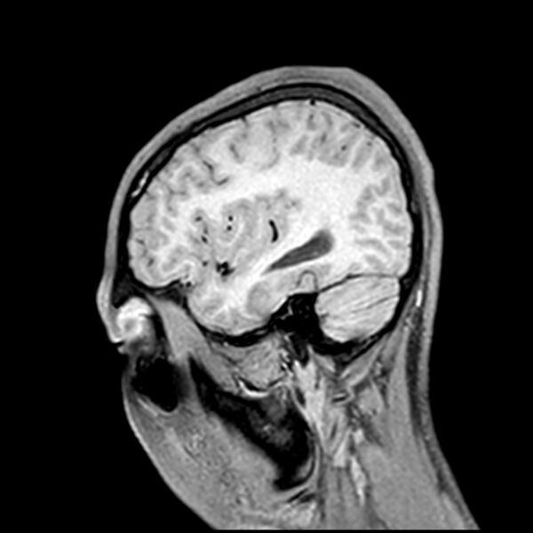 File:Central neurocytoma (Radiopaedia 79320-92380 Sagittal T1 200).jpg