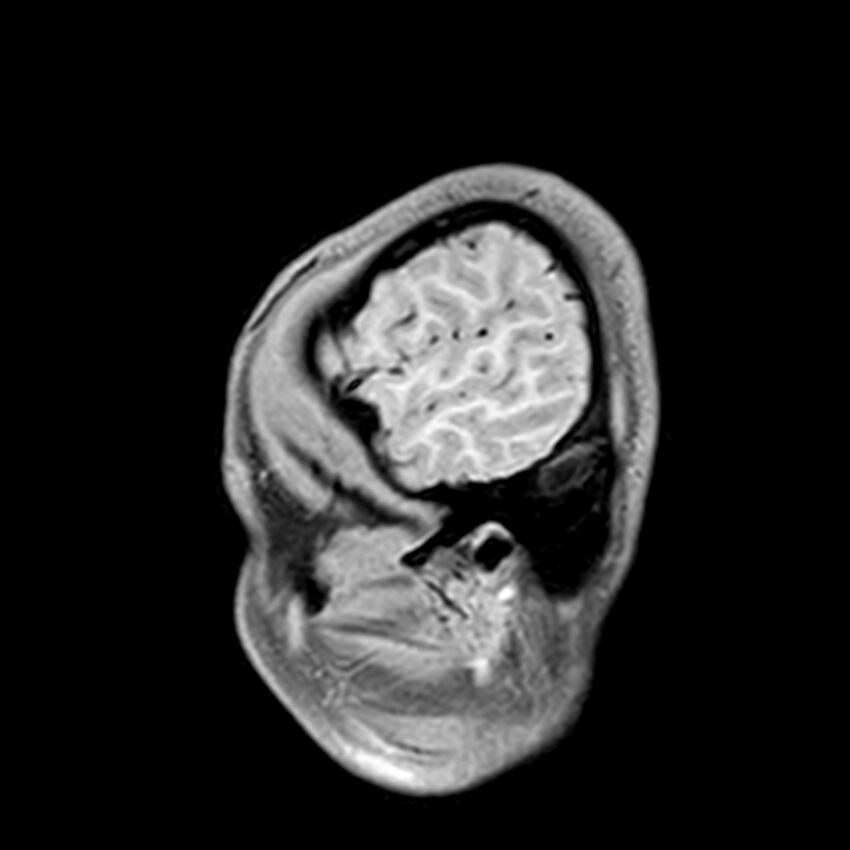 Central neurocytoma (Radiopaedia 79320-92380 Sagittal T1 33).jpg