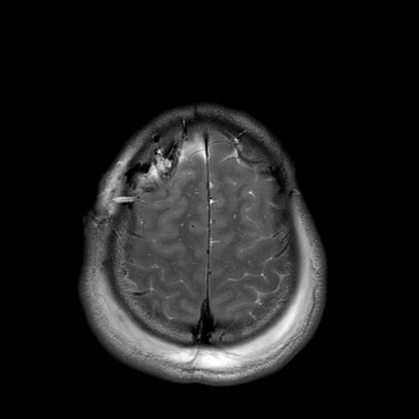 File:Central neurocytoma (Radiopaedia 79320-92381 Axial T2 23).jpg