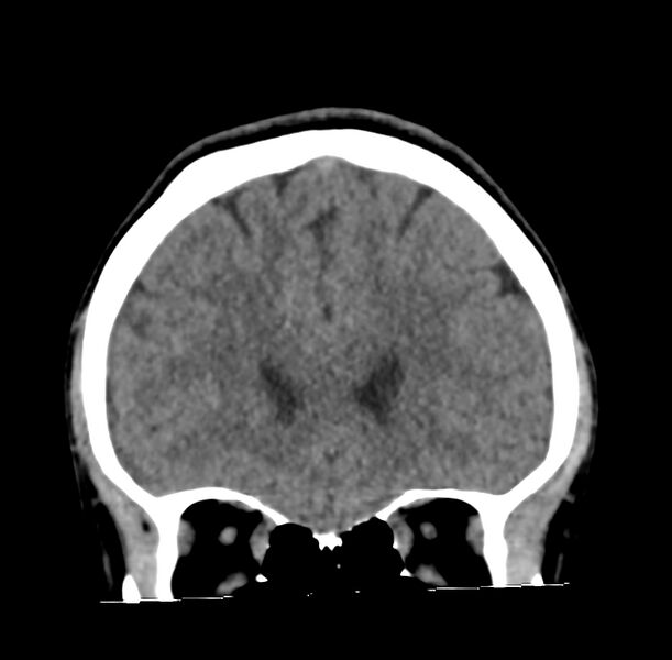 File:Cerebellar agenesis (Radiopaedia 30203-30817 Coronal non-contrast 4).jpg