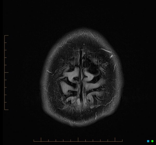 File:Cerebellar gangliocytoma (Radiopaedia 65377-74422 Axial FLAIR 37).jpg