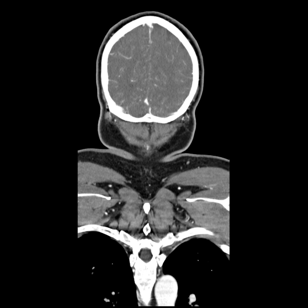File:Cerebellar infarct due to vertebral artery dissection with posterior fossa decompression (Radiopaedia 82779-97029 D 55).png