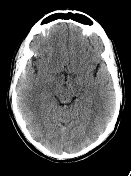 File:Cerebellar infarct due to vertebral artery dissection with posterior fossa decompression (Radiopaedia 82779-97032 Axial non-contrast 12).png