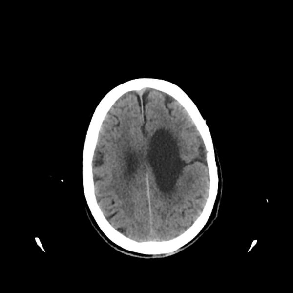 File:Cerebellar metastasis - lung tumor (Radiopaedia 69317-79145 Axial non-contrast 28).jpg