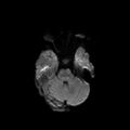 Cerebral abscess post cardiac surgery (Radiopaedia 27244-27420 Axial DWI 3).jpg