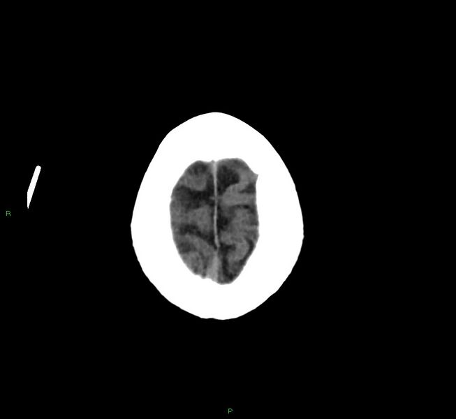 File:Cerebral amyloid angiopathy-associated lobar intracerebral hemorrhage (Radiopaedia 58376-65513 Axial non-contrast 6).jpg