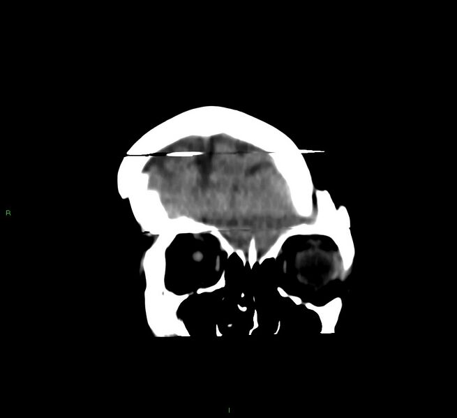 File:Cerebral amyloid angiopathy-associated lobar intracerebral hemorrhage (Radiopaedia 58377-65514 Coronal non-contrast 55).jpg
