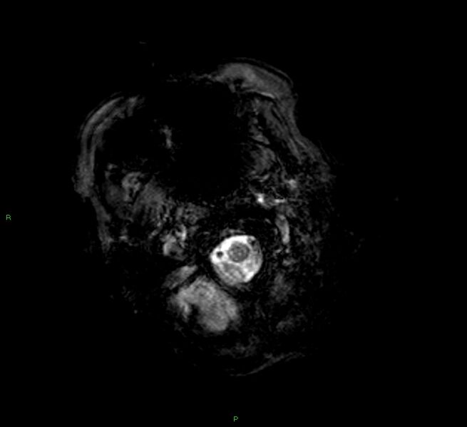 File:Cerebral amyloid angiopathy-associated lobar intracerebral hemorrhage (Radiopaedia 58377-65515 Axial Gradient Echo 23).jpg
