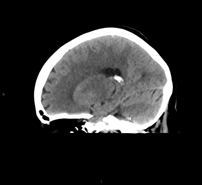 Cerebral amyloid angiopathy-associated lobar intracerebral hemorrhage (Radiopaedia 58378-65516 C 20).jpg