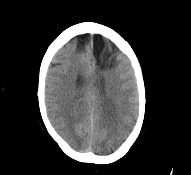 File:Cerebral amyloid angiopathy-associated lobar intracerebral hemorrhage (Radiopaedia 58529-65686 Axial non-contrast 17).jpg