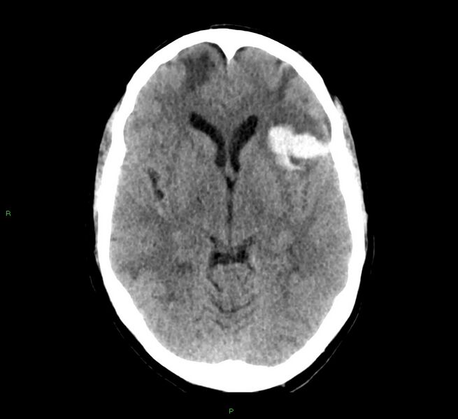 File:Cerebral amyloid angiopathy-associated lobar intracerebral hemorrhage (Radiopaedia 58529-65687 Axial non-contrast 30).jpg