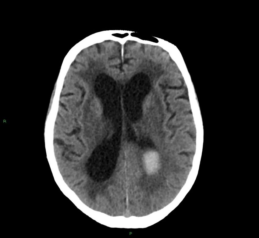 Cerebral amyloid angiopathy-associated lobar intracerebral hemorrhage (Radiopaedia 58530-65688 Axial non-contrast 22).jpg