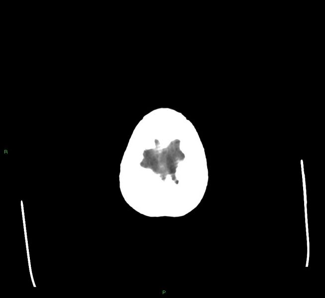 File:Cerebral amyloid angiopathy-associated lobar intracerebral hemorrhage (Radiopaedia 58560-65723 Axial non-contrast 5).jpg