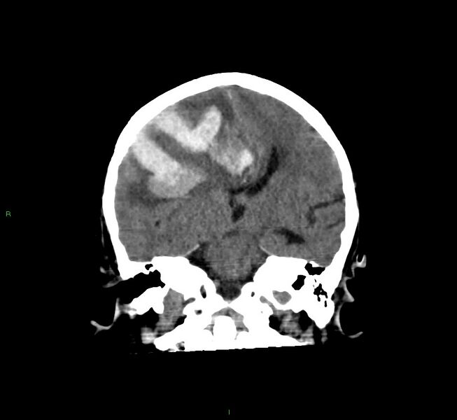 File:Cerebral amyloid angiopathy-associated lobar intracerebral hemorrhage (Radiopaedia 58560-65723 Coronal non-contrast 37).jpg
