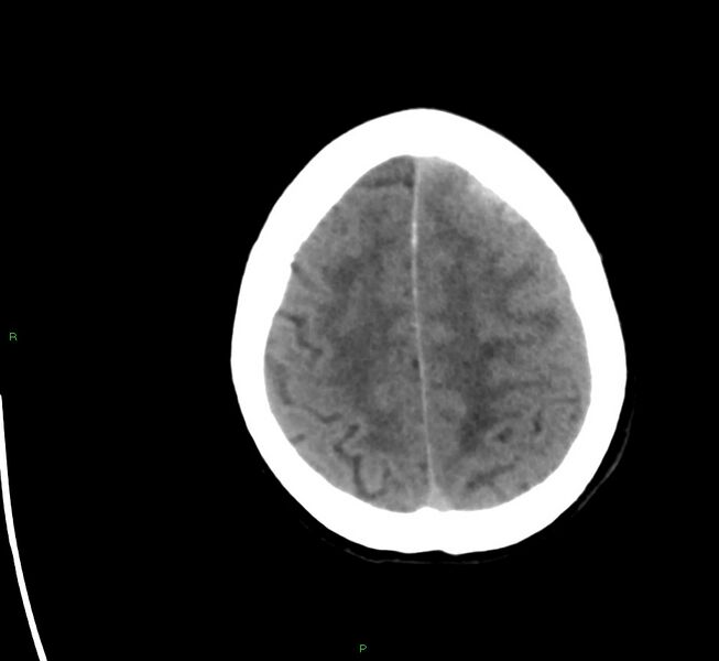 File:Cerebral amyloid angiopathy-associated lobar intracerebral hemorrhage (Radiopaedia 58561-65724 Axial non-contrast 9).jpg