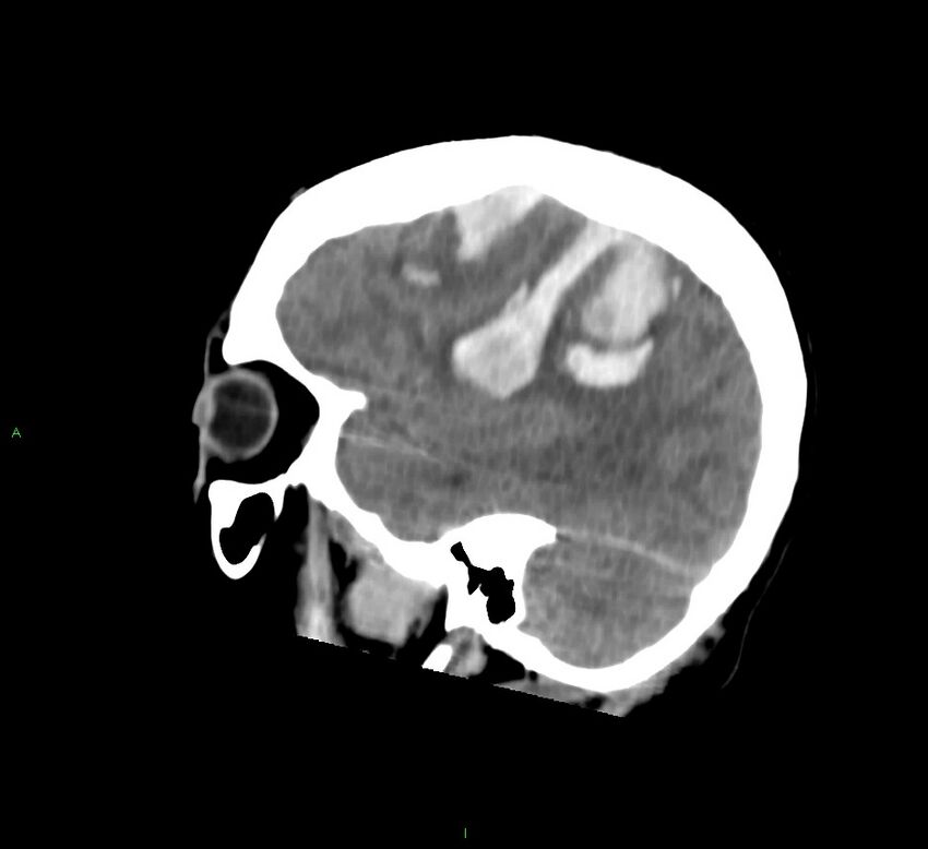 Cerebral amyloid angiopathy-associated lobar intracerebral hemorrhage (Radiopaedia 58756-65977 C 17).jpg