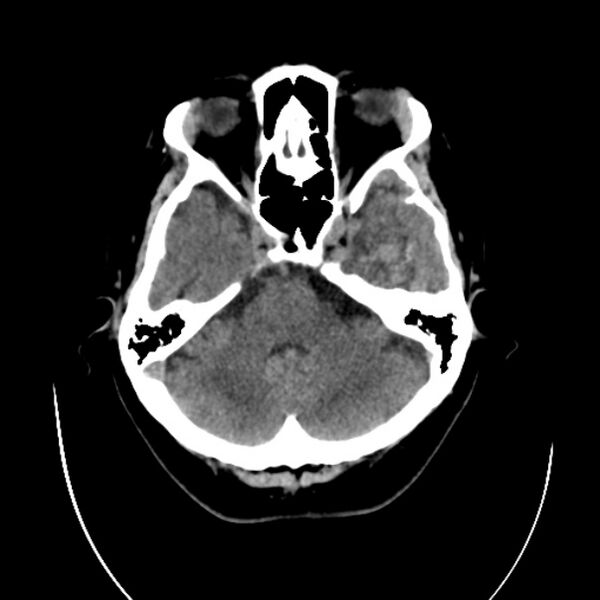File:Cerebral arteriovenous malformation (Radiopaedia 43729-47189 Axial non-contrast 9).jpg