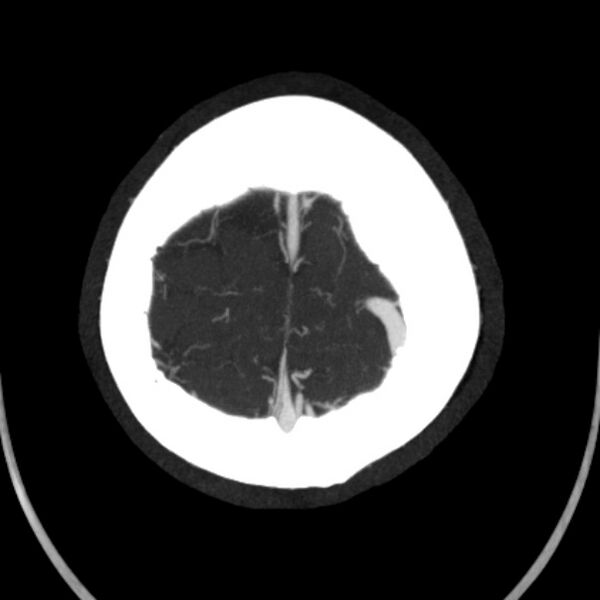 File:Cerebral arteriovenous malformation (Radiopaedia 43729-47189 B 45).jpg