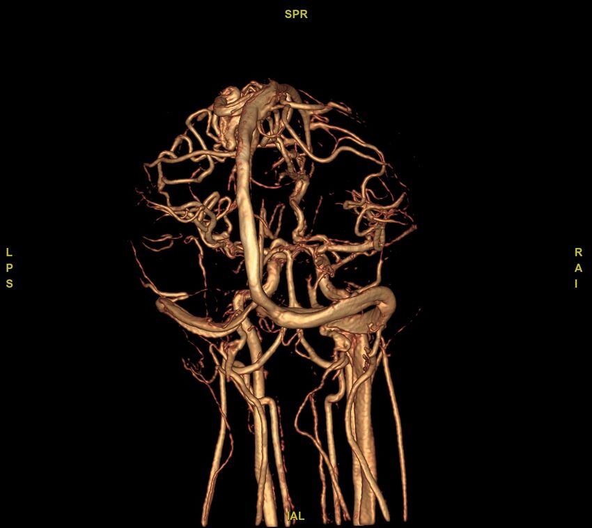 Cerebral arteriovenous malformation (Radiopaedia 61964-70029 VRT 17).jpg